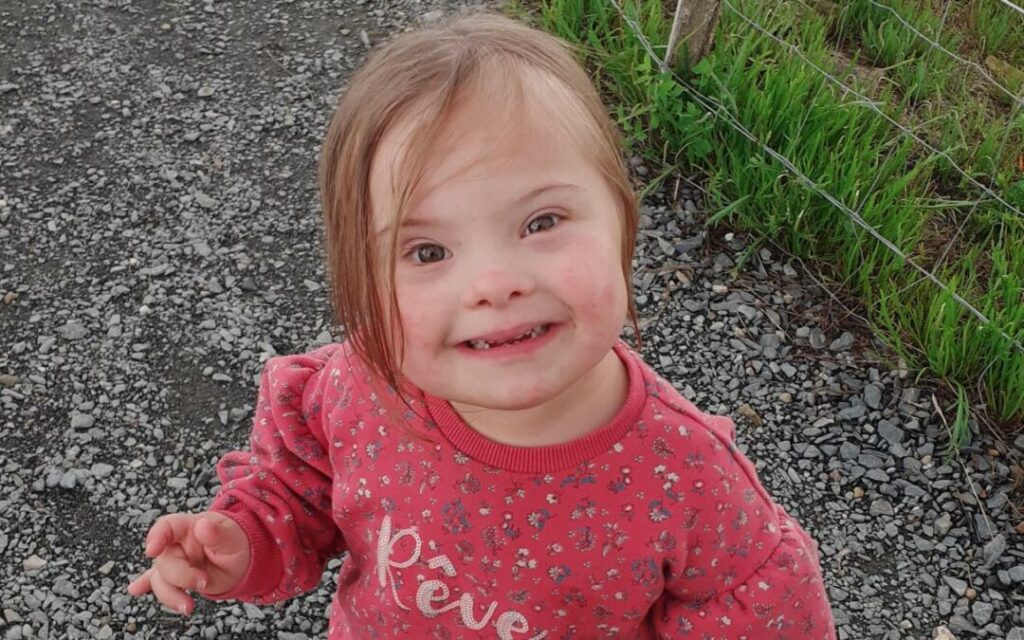 retardasi mental vs down syndrome