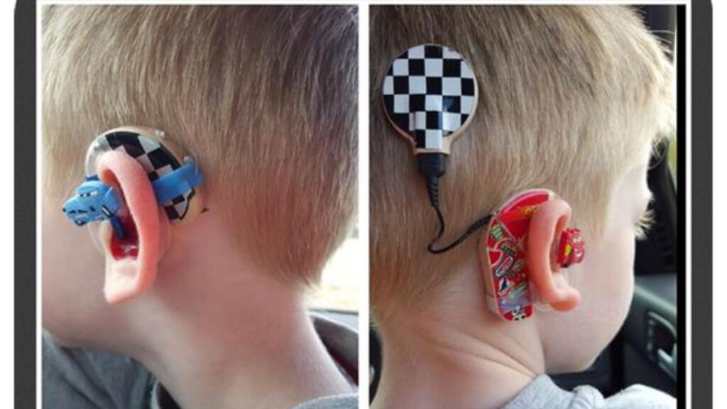 Cara Pilih Alat Bantu Dengar Buat Anak Distrofi Otot