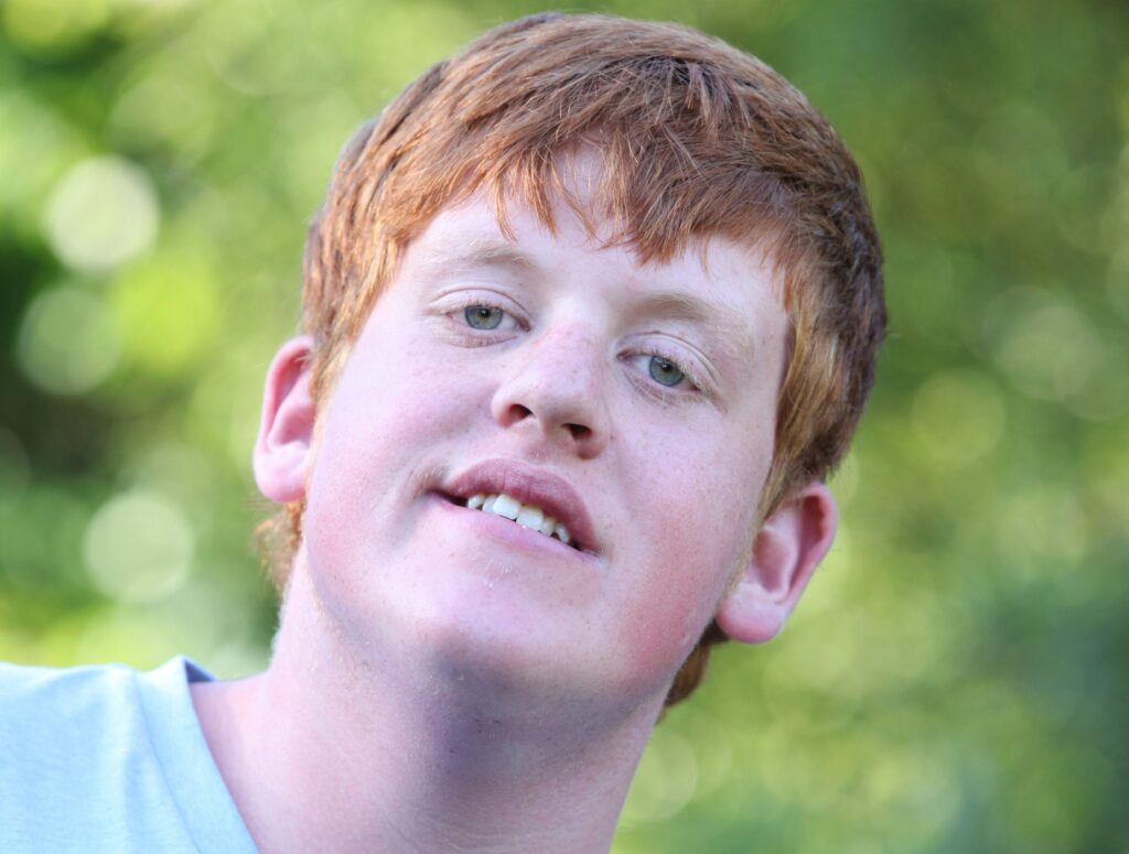 Fragile X Syndrome dan masalah mata