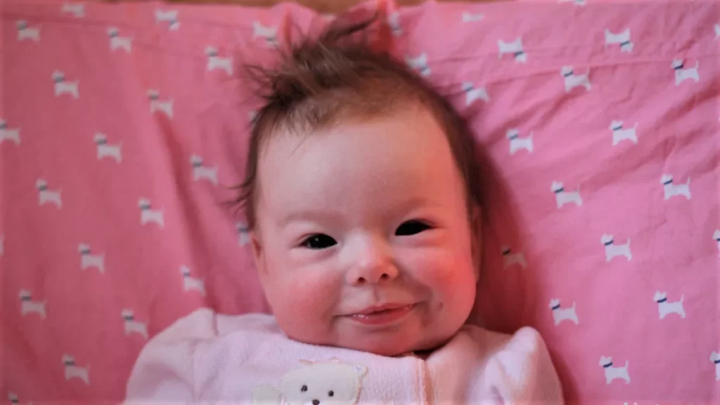 Williams Syndrome dan Masalah Pernapasan