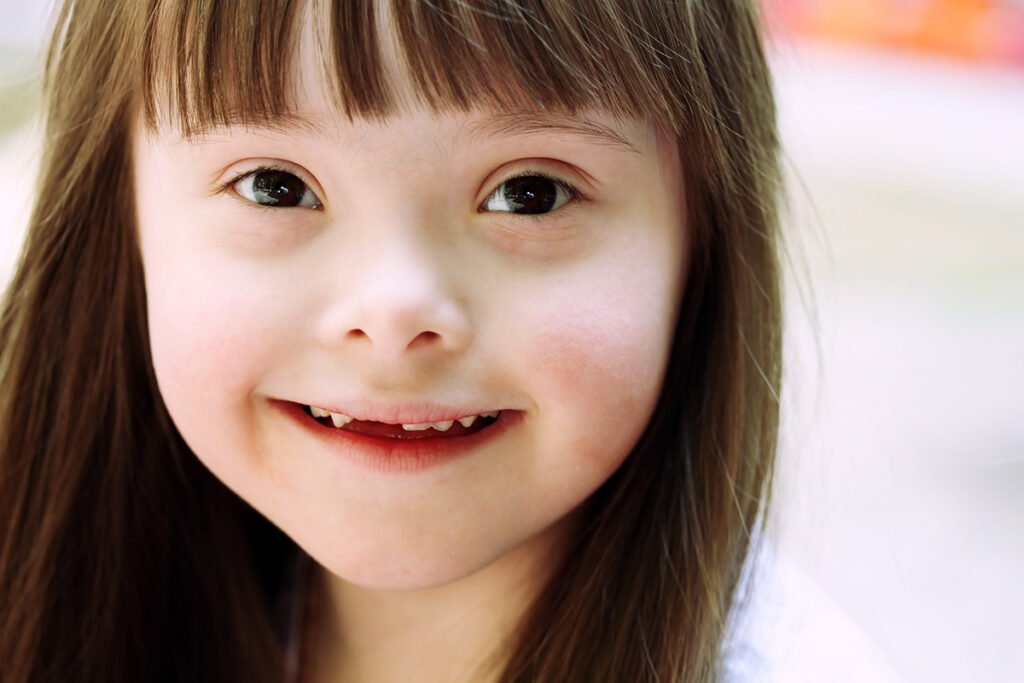 down syndrome dan masalah gigi