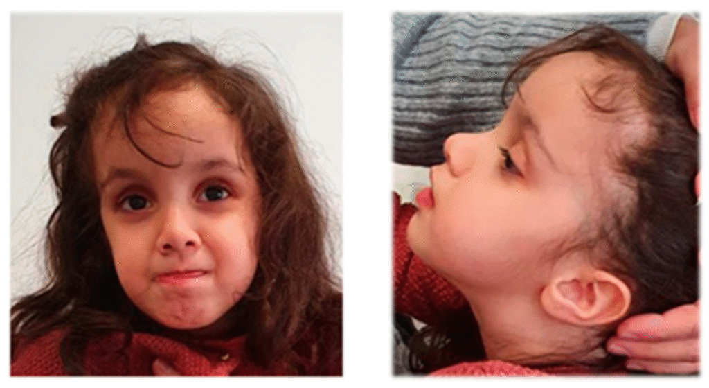 fragile x syndrome dan masalah pencernaan