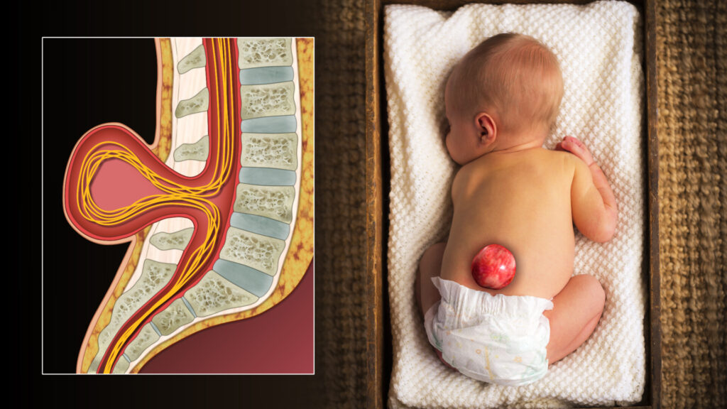 spina bifida dan masalah pencernaan anak