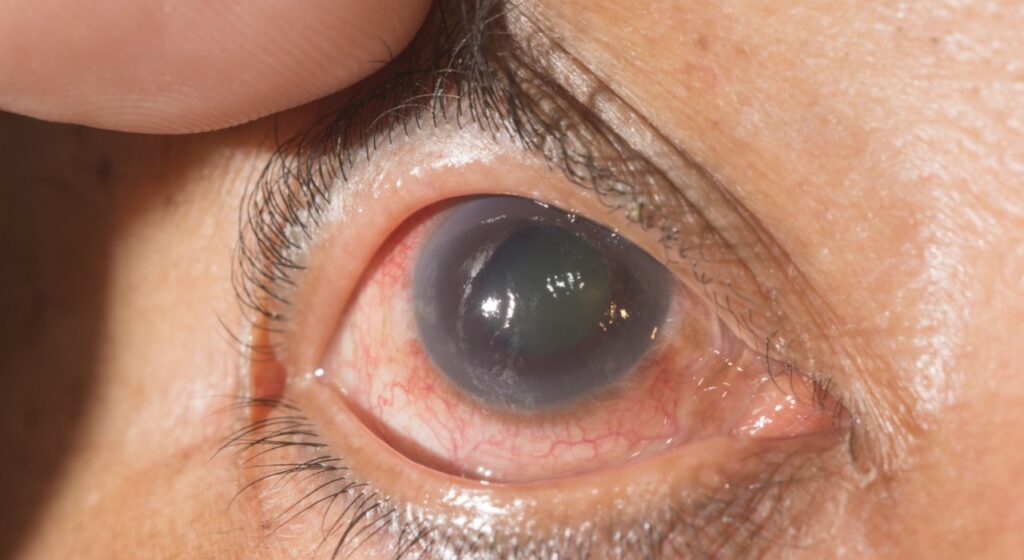 Aman Atasi Glaukoma dengan Cara Terapi Ini Jawabannya