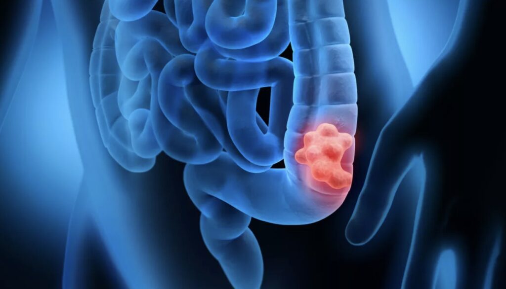 Apa Benar Makan Pedas Bikin Polip Cepat Jadi Kanker