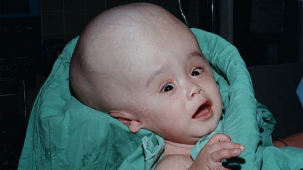 Cara Mengatasi Hidrocephalus Pada Anak