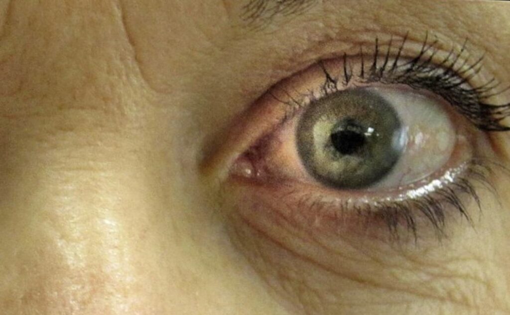 Glaukoma Cuma Penyakit Orang Lanjut Usia, Mitos atau Fakta