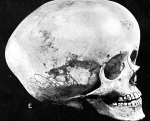 Ini 5 Ciri Hidrocephalus Bisa Terjadi pada Orang Dewasa