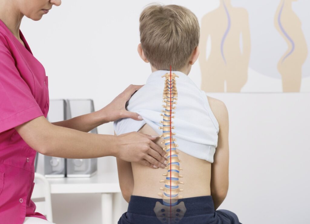 Kenapa Penanganan Skoliosis Harus Tepat di Tempat Terapi