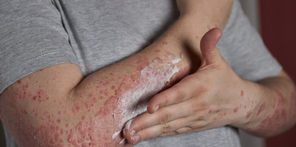 Lupus Menular Lewat Sentuhan Ini Mitos atau Fakta Wajib Tahu