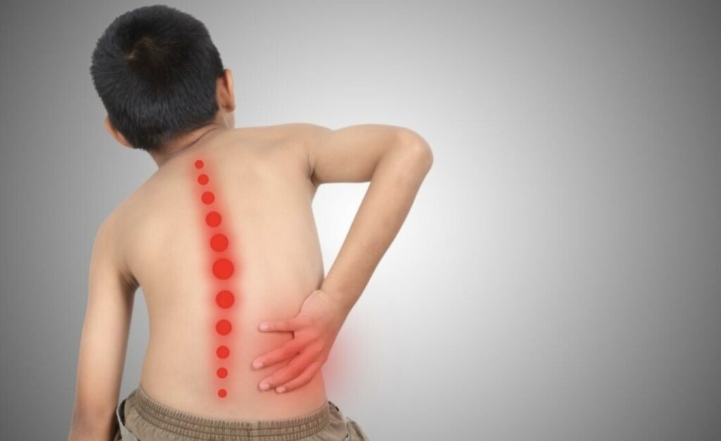 Mengenal Skoliosis yang Bisa Sembuh Total Tanpa Operasi