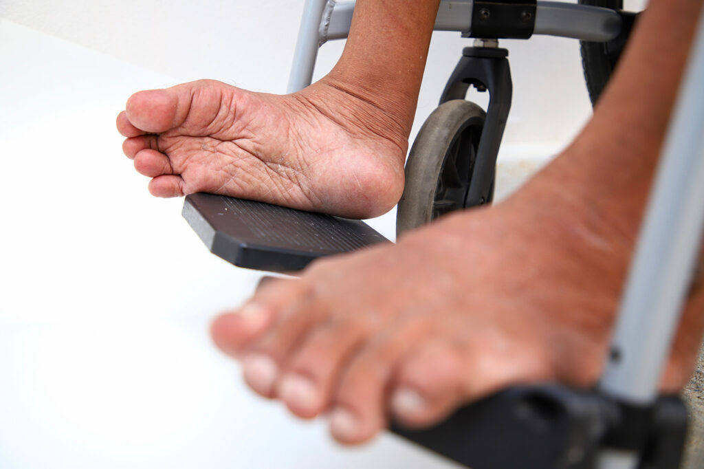 Pemulihan Otot Pasca Polio pada Anak