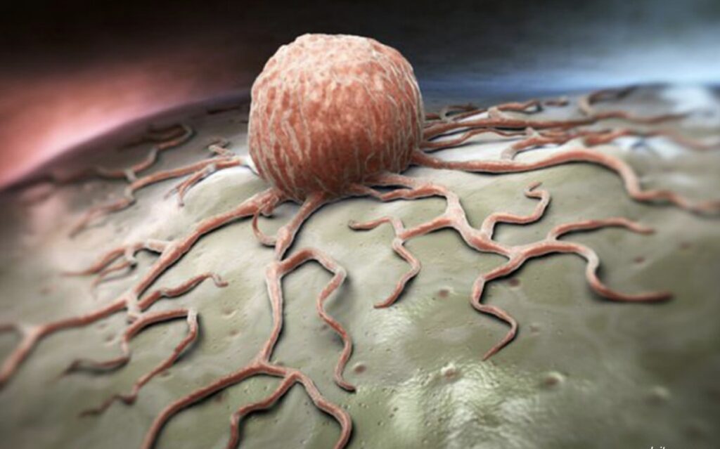 Wajib Tahu, 4 Sarapan untuk Atasi Tumor yang Anda Derita