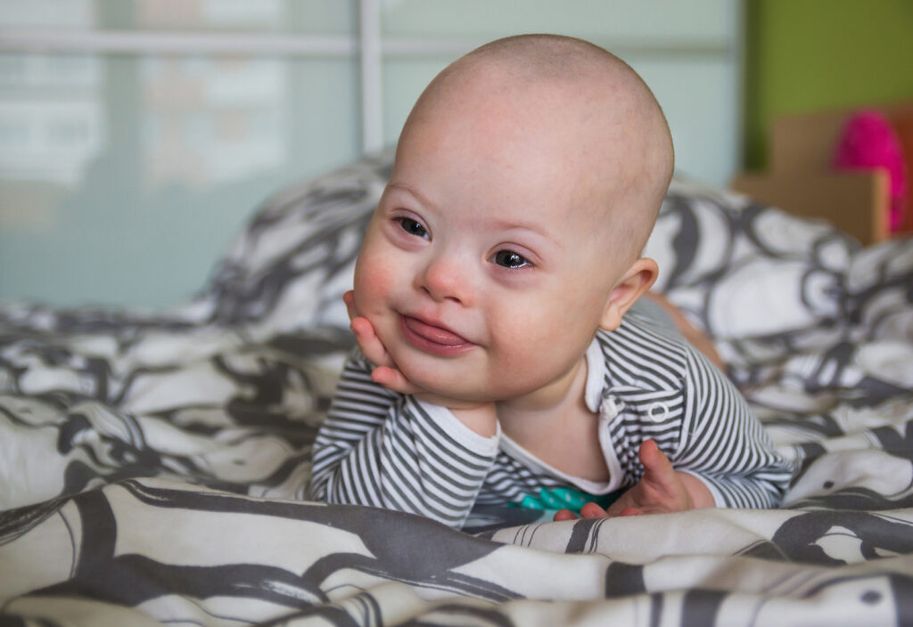 down syndrome dan masalah pencernaan