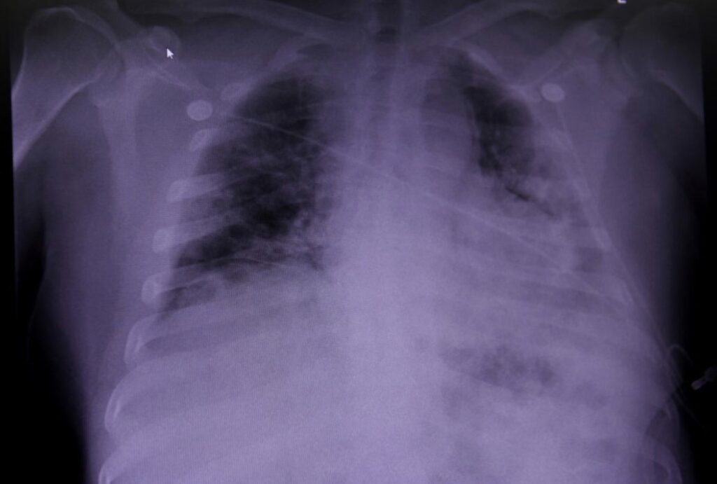 4 Makanan Wajib buat yang Lagi Pemulihan Pneumonia