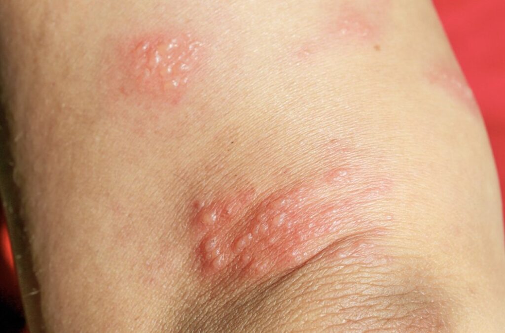 Anak Perempuan sedang Autoimun, Ini 3 Cara Terbebas Hal Ini