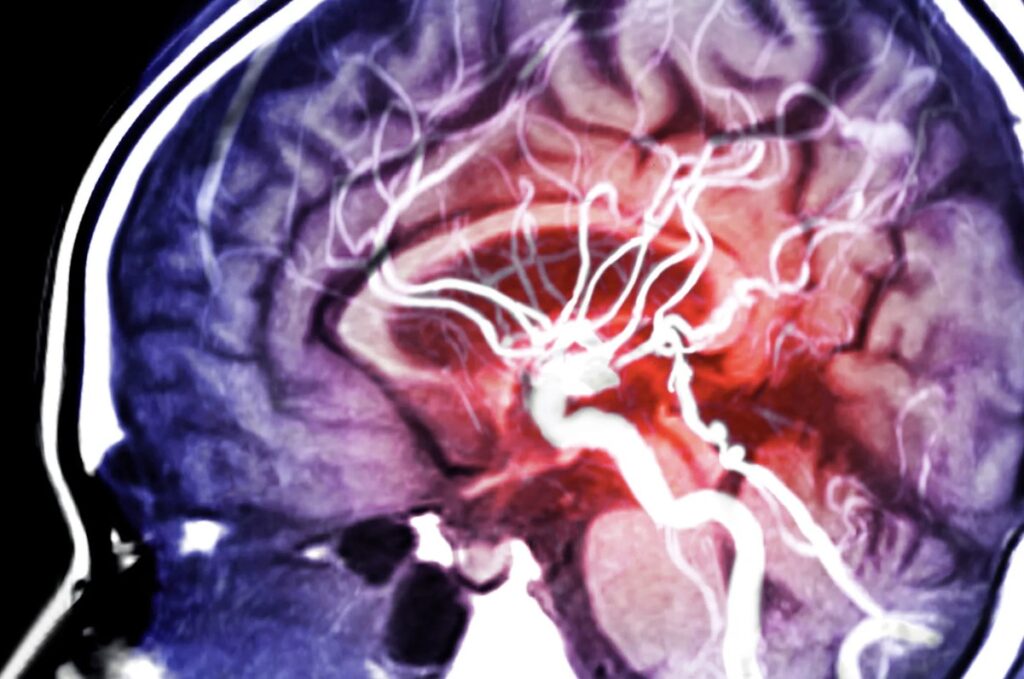 Kapan Anda Harus Panik saat Mengalami Stroke