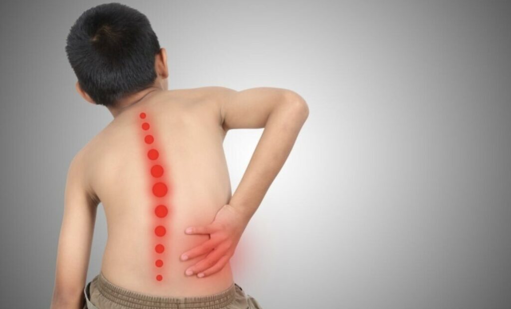 Kapan Sebaiknya Anak Skoliosis Mulai Ikut Terapi