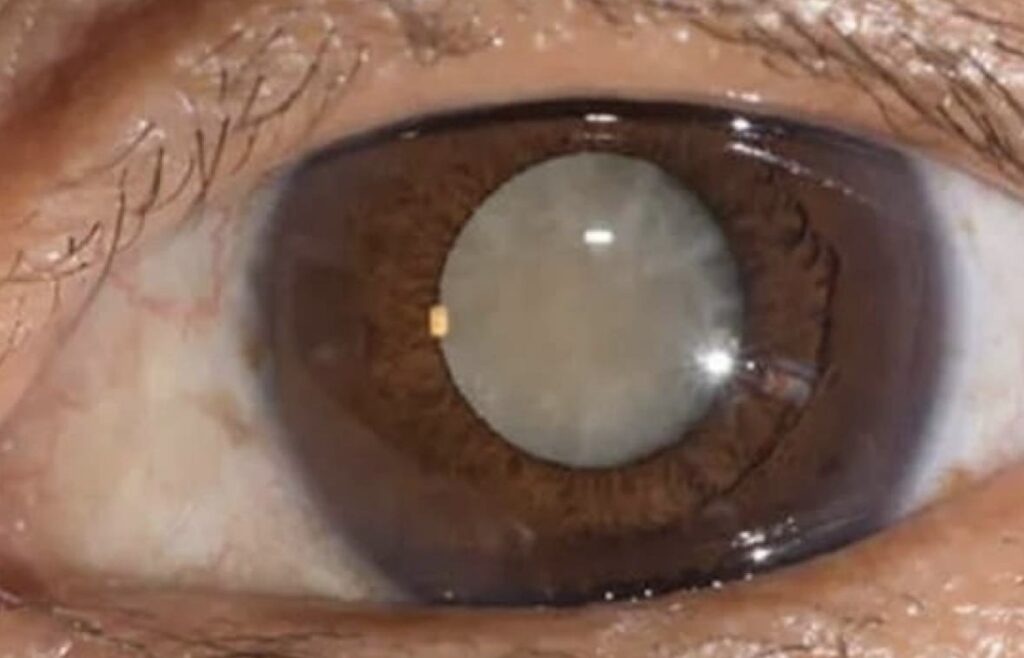 Kenali Glaukoma 'Terselubung' pada Tekanan Normal