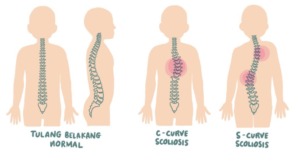 Kisah Pejuang Skoliosis Menerima Bentuk Tubuh yang Berbeda