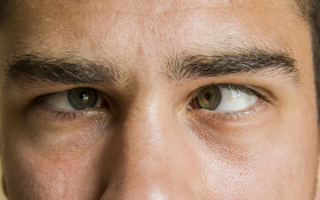 Mata Juling pada Dewasa