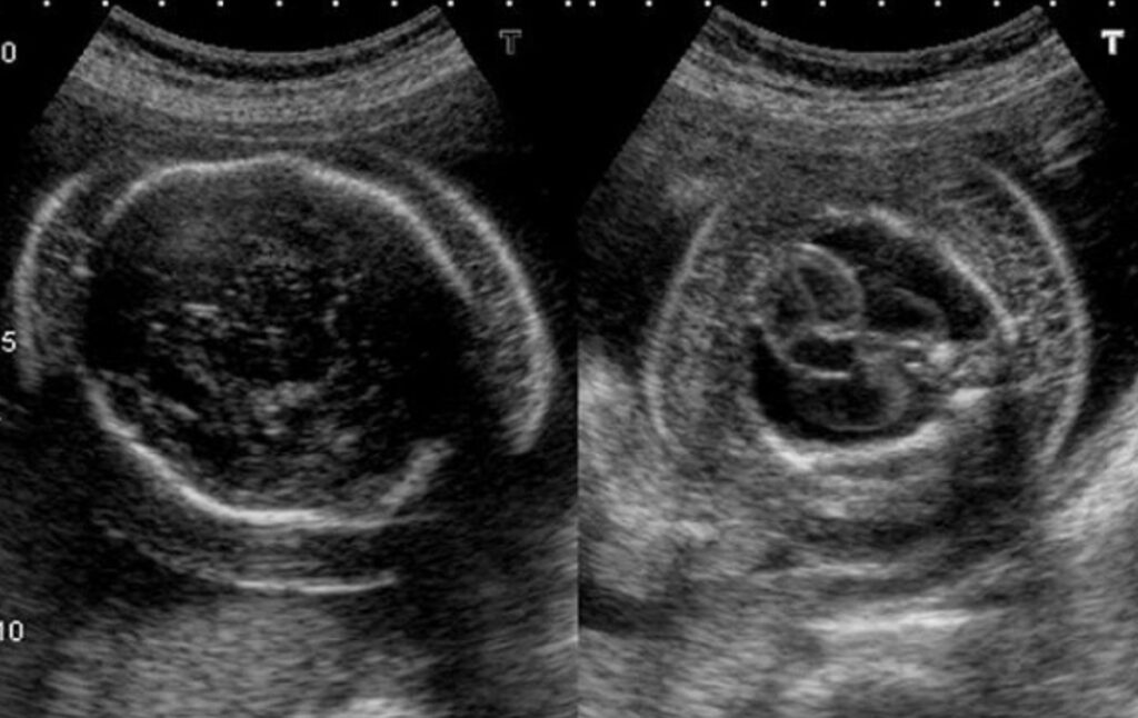 Deteksi Sejak Dini Hidrosefalus pada Bayi Sejak di Kandungan
