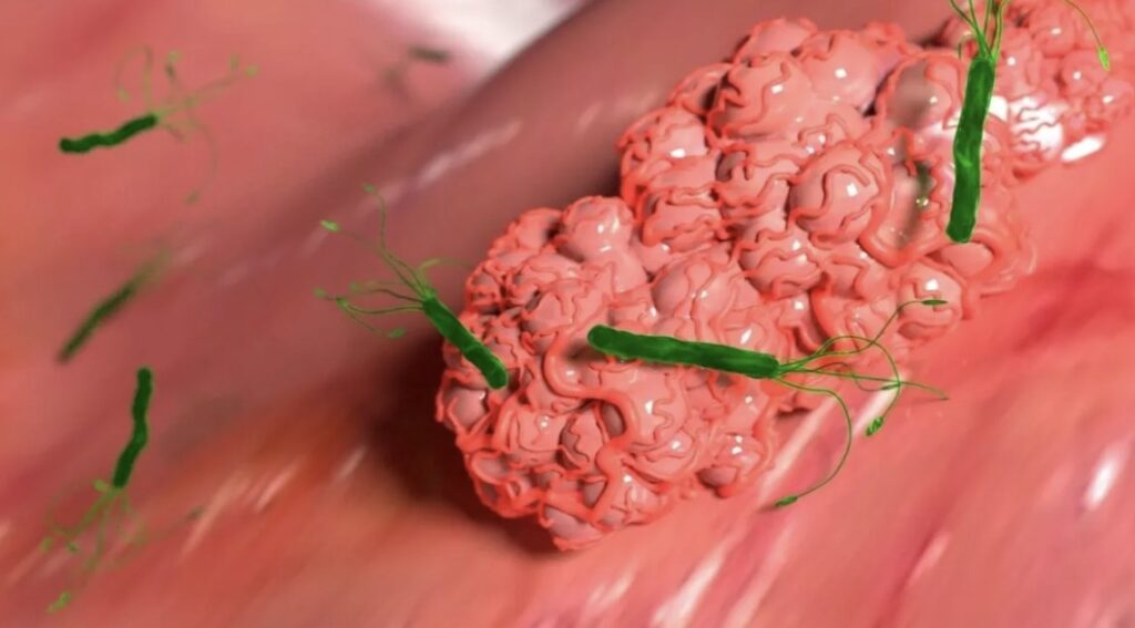 Tumor Jinak VS Ganas, yang Paling Bahaya Ini Jawabannya