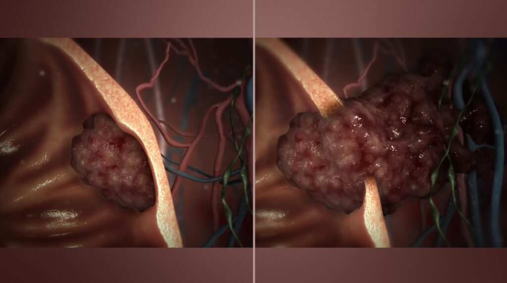 Tumor Bukan Akhir Segalanya, 3 Cerita Bangkit Keterpurukan