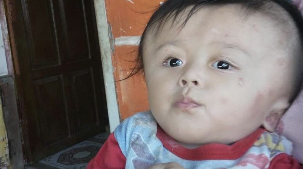 Kenapa Mata Anak Hidrosefalus Sering Melihat Ke Bawah Ini Jawabannya