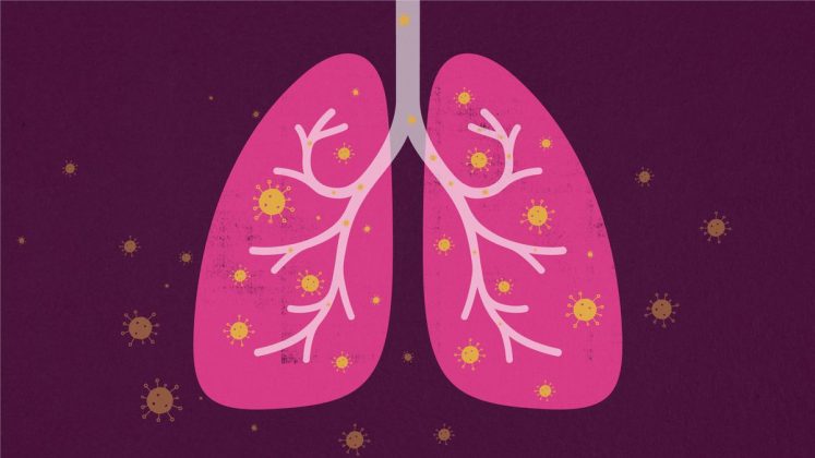 Tempat Pengobatan Paru-Paru Lemah di Bogor Paling Aman - Tempat