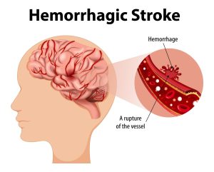 stroke hemoragik