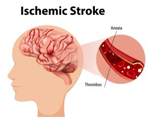 stroke iskemik