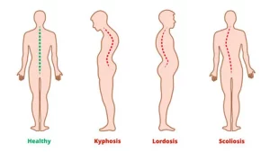 skoliosis medical hacking
