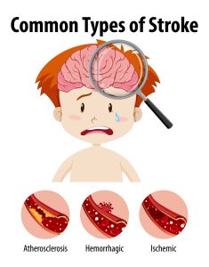 Kisah Nyata Stroke Lemah Berjalan, 3 Treatment Ajaib Ini Bisa Bikin Jalan Lagi