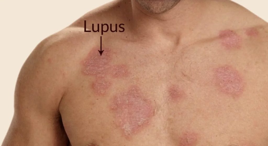 4 Cara Membedakan Lupus dengan Penyakit Autoimun Lain