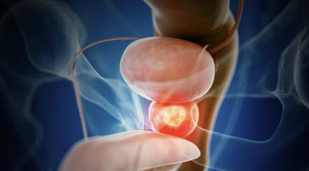 7 Cara Mencegah Prostat Sebelum Terlambat