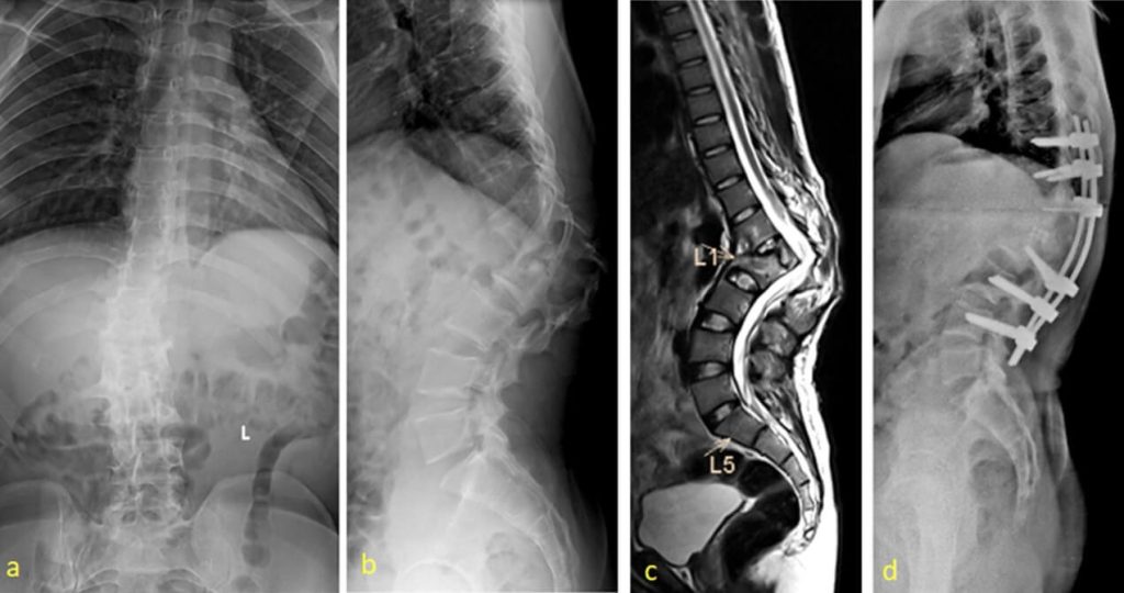 Anda Pernah Infeksi Tulang Sudah Diobati lalu Belum Sembuh