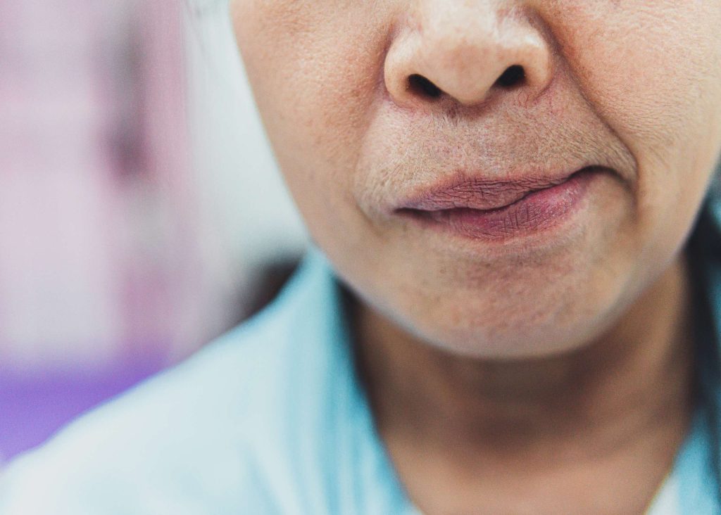 Bell's Palsy ringan