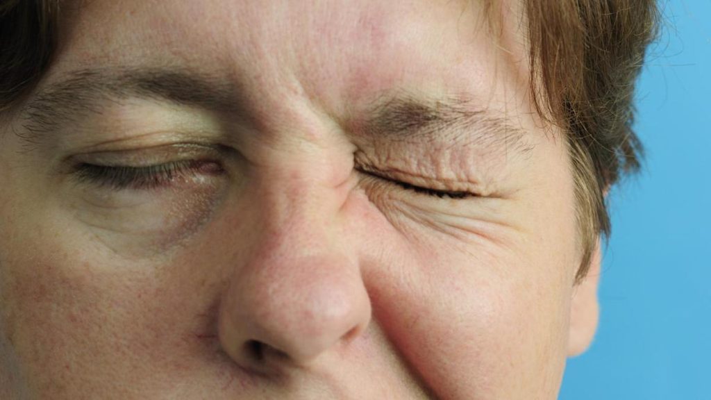 Bell's Palsy treatment