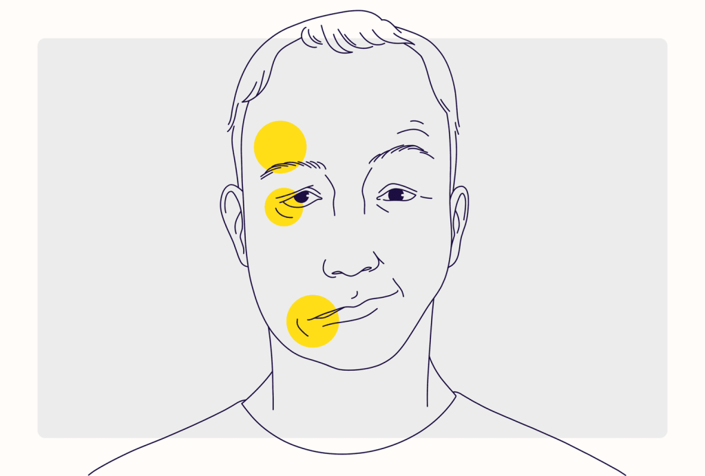 bell’s palsy gejala