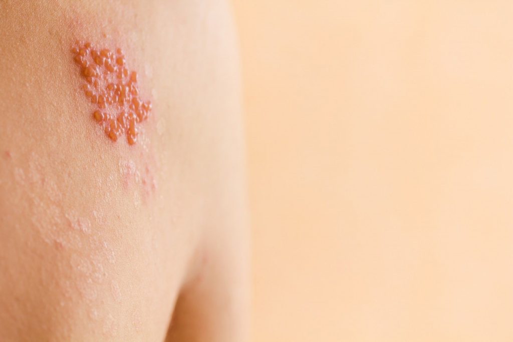 The current image has no alternative text. The file name is: herpes-zoster-article-1598286660-e1753157080965.jpg