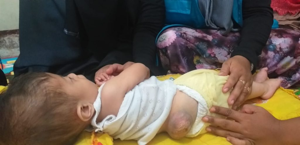Hak pendidikan anak spina bifida di Indonesia