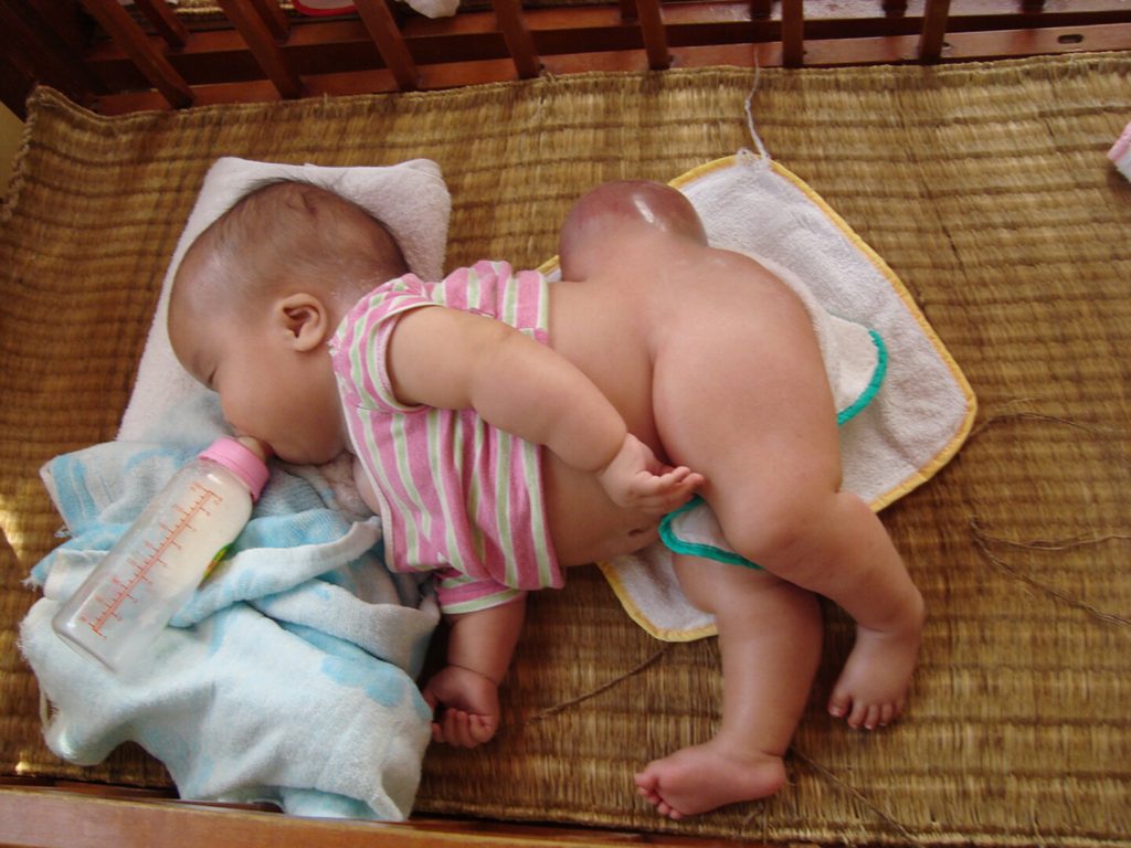 cara merawat luka anak spina bifida