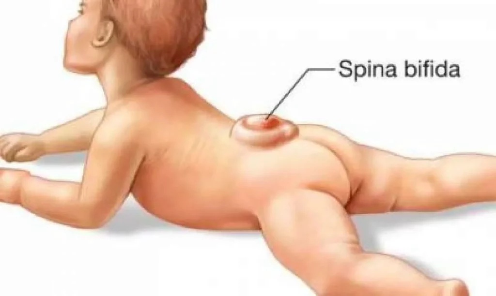 terapi akuatik untuk anak spina bifida